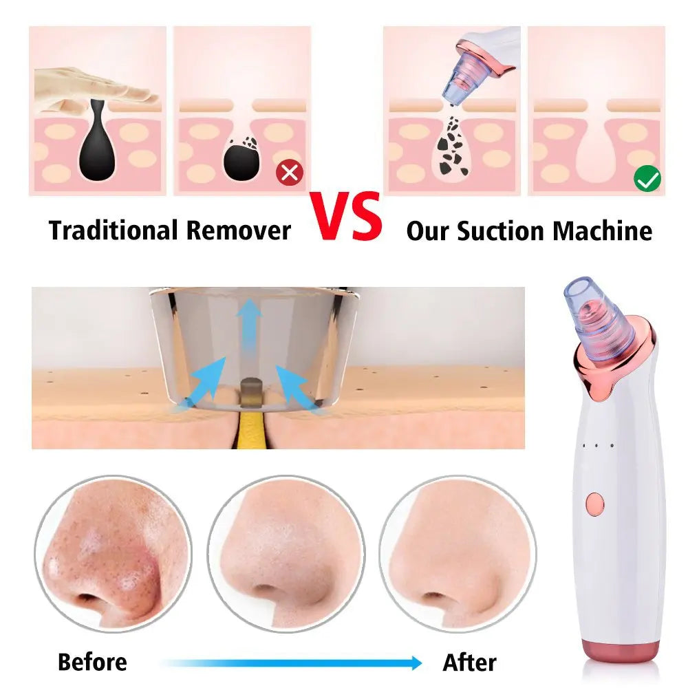ClearSkin Pro Blackhead Remover
