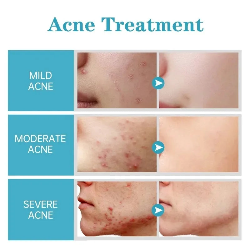 Effective Acne Treatment Repair Spots Salicylic Acid Acne Removal Serum Moisturizing Oil Control Shrink Pore Skin Care