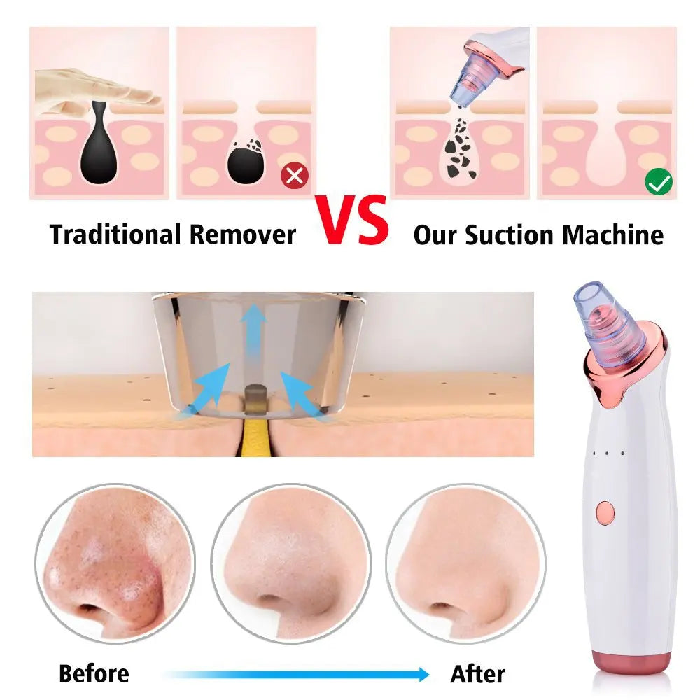 Blackhead Remover Vacuum Suction Pore Cleaner Acne Extractor Acne Comedone Whitehead Pimple Removal Spot Cleaner Skin Care Tool