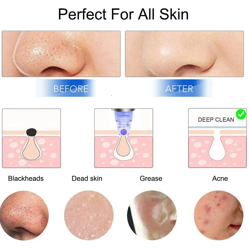 Blackhead Remover Vacuum Suction Pore Cleaner Acne Extractor Acne Comedone Whitehead Pimple Removal Spot Cleaner Skin Care Tool