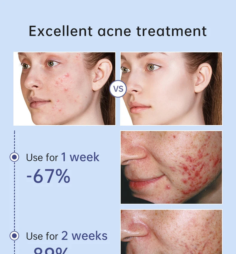 Effective Acne Treatment Repair Spots Salicylic Acid Acne Removal Serum Moisturizing Oil Control Shrink Pore Skin Care