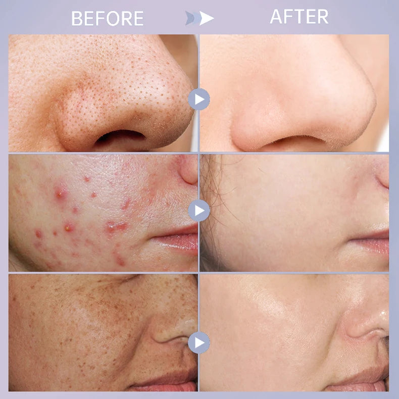 Effective Acne Treatment Repair Spots Salicylic Acid Acne Removal Serum Moisturizing Oil Control Shrink Pore Skin Care