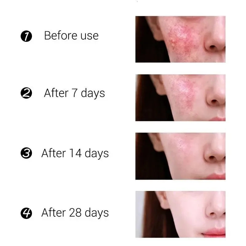 Effective Acne Treatment Repair Spots Salicylic Acid Acne Removal Serum Moisturizing Oil Control Shrink Pore Skin Care