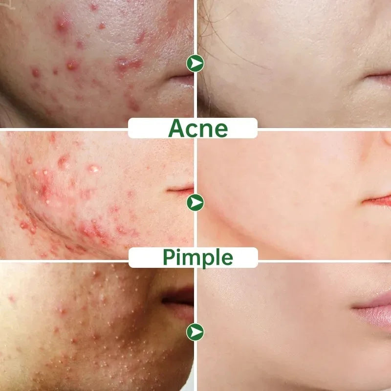 Effective Acne Treatment Repair Spots Salicylic Acid Acne Removal Serum Moisturizing Oil Control Shrink Pore Skin Care